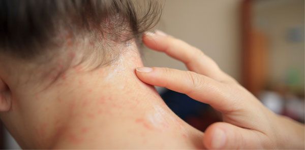12 cách điều trị viêm nang lông nhẹ tại nhà hiệu quả và tiết kiệm 1