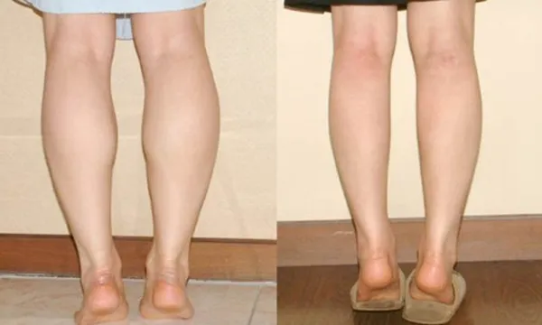 Tập thon gọn bắp chân trên giường có hiệu quả không?