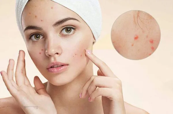 Top 11 kem chấm mụn hiệu quả nhanh được tin dùng nhất