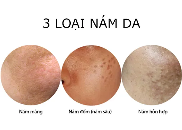 Peel Da Sinh Học SkinClinic Melanyc Clay K Dành Cho Da Nám 90g - Mỹ phẩm - Vua Hàng Hiệu