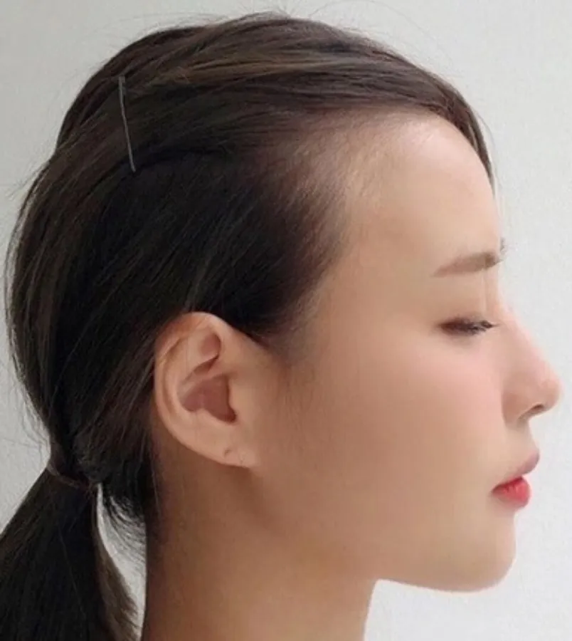10+ kiểu tóc cho người hói chữ M nữ đẹp nhất - 1