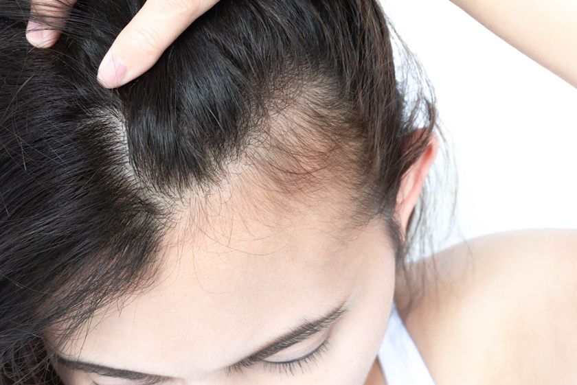 Rụng tóc sau sinh là gì? 13 cách ngăn ngừa tóc rụng cho mẹ bỉm sữa-3
