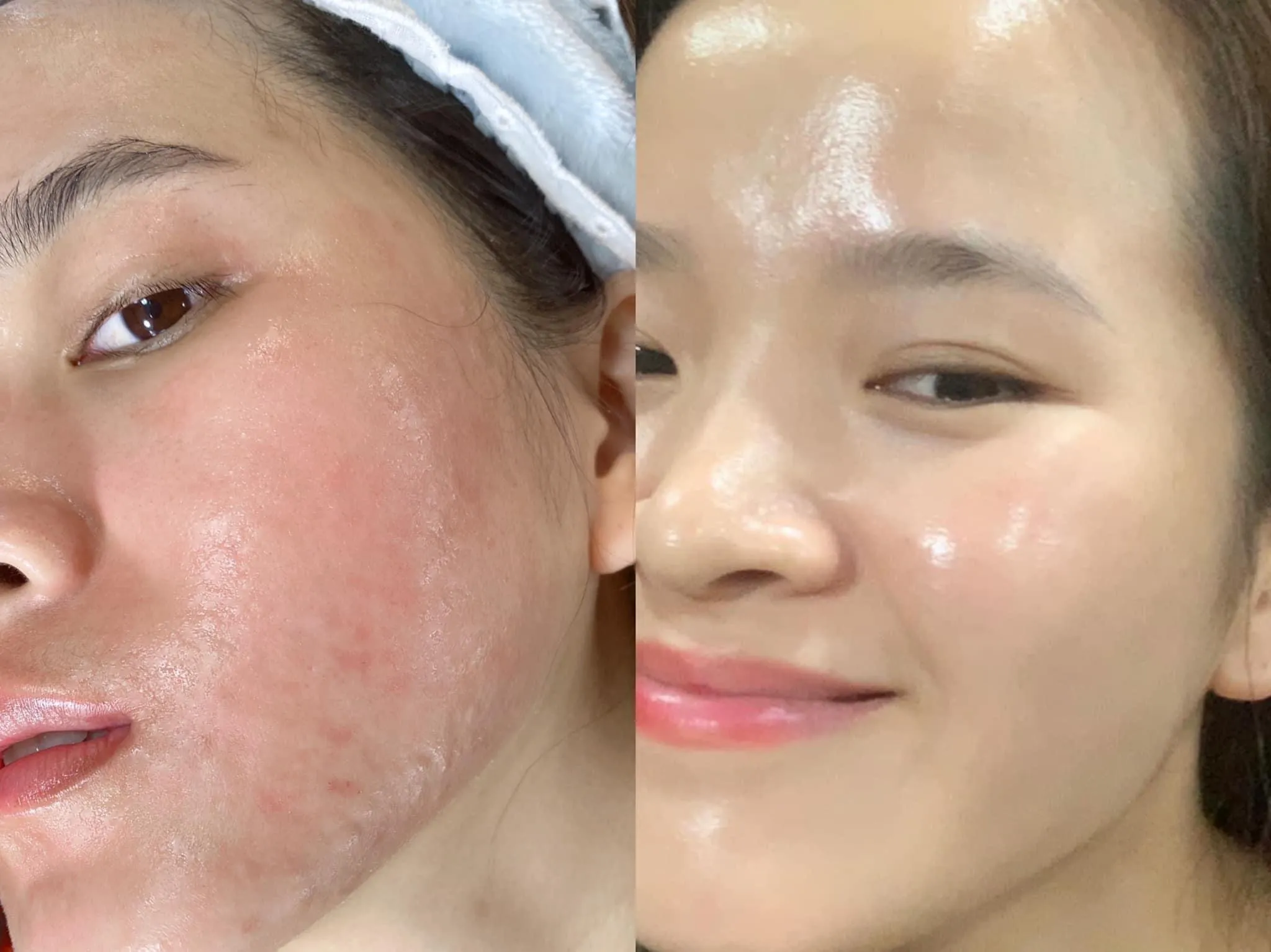 Hiệu quả chăm sóc da Smas vượt trội