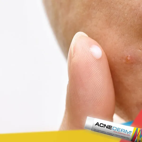 Kem Giảm Mụn Mờ Thâm UNIA Acne-Derm Kwas Azelainowy 20g