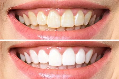 13 cách làm trắng răng tại nhà an toàn, siêu tiết kiệm 