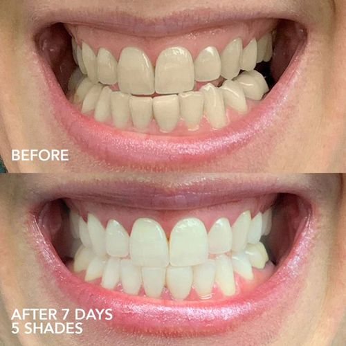Bộ Thiết Bị Làm Trắng Răng Glo Science Glo Lit™ At-Home Teeth Whitening Device Trắng-5