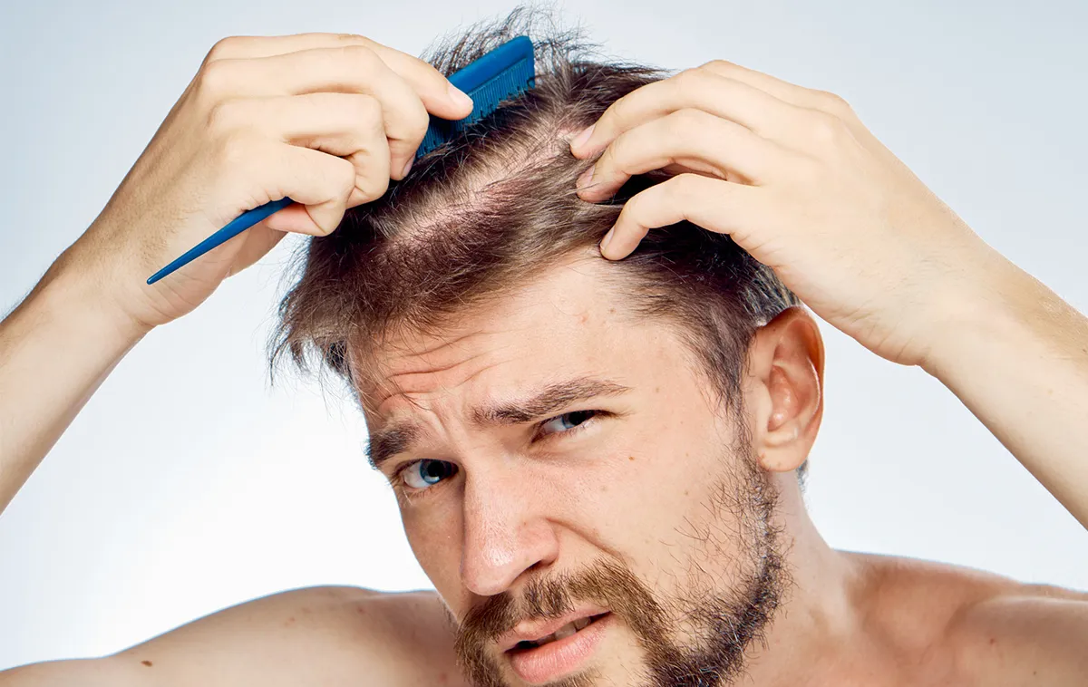 Rụng tóc ở nam giới – Nguyên nhân do đâu? Có phải do bệnh lý?